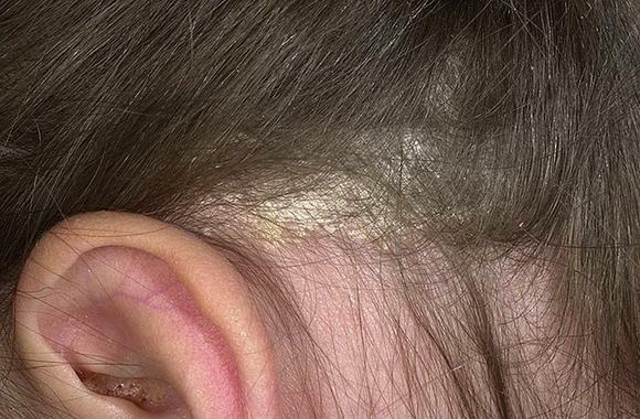 Seborrhea on the scalp