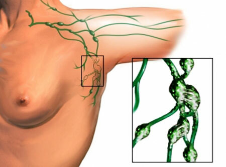 Signs and symptoms of inflammation of the lymph nodes