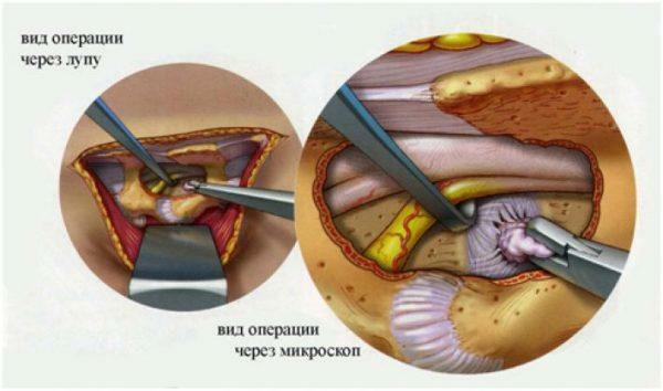 Behandeling van lumbale hernia hernia
