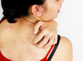 Allergic reactions in the form of itching