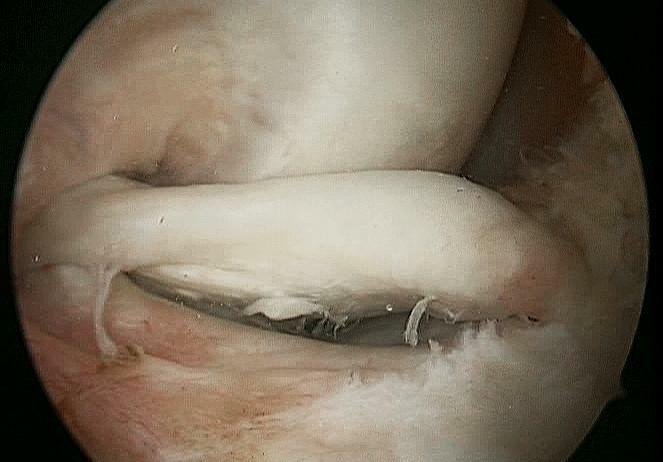 Tip de ruptură artroscopică a cornului și a corpului meniscului medial