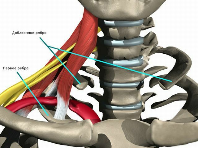 cervical rib szindróma