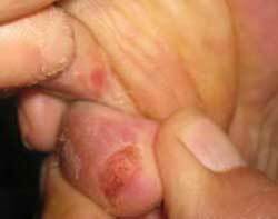 Forms of fungal infection of feet