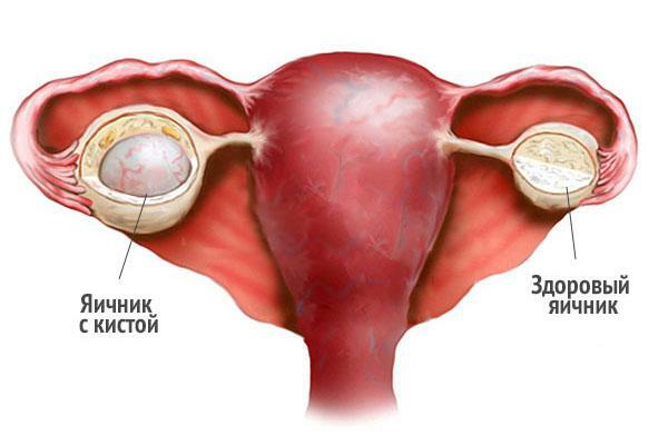 Forskellen mellem en sund ovarie og en æggestok med en cyste