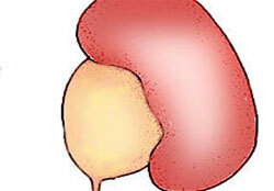 Gradul de hidronefroză a rinichilor