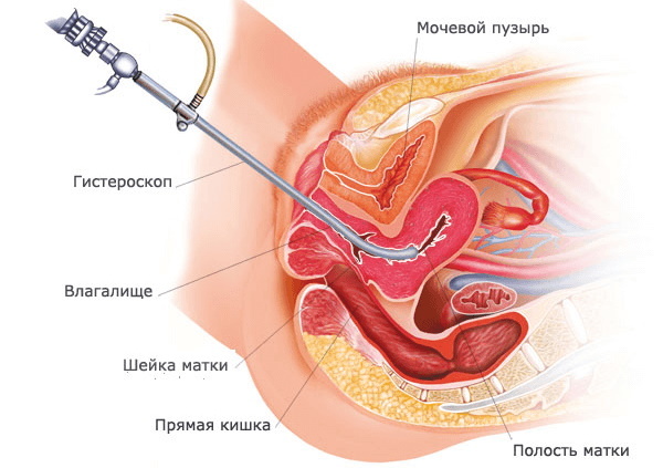 Laser removal of a polyp of the uterus, endometrial hysteroscopy. Preparation, recovery period
