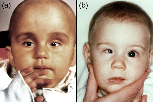 Toksoplazmoza u djece. Simptomi, liječenje, kliničke smjernice