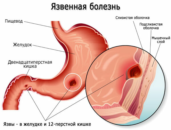 Thick bile. Causes and treatment, symptoms, what to do, medications, how to thin, diet