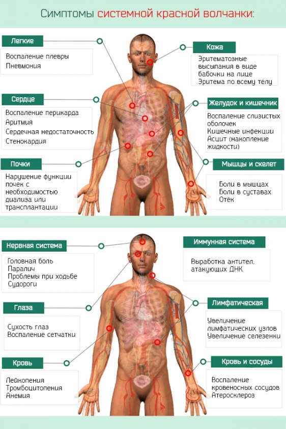 Lupus erythematosus. What is this disease, symptoms, causes. As transmitted, treatment