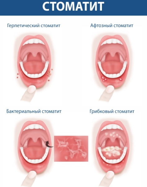 Rotokan (Rotocanum) til skylning af tandkødet i tilfælde af betændelse. Hvordan man opdrætter, ansøgning, pris, anmeldelser