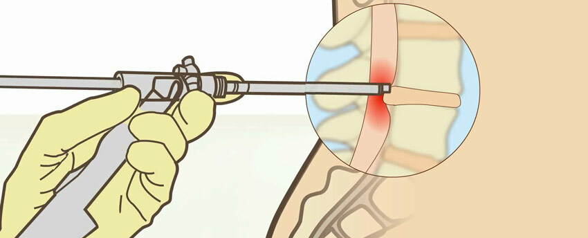 Endoskopische Behandlung einer Hernie der Lendenwirbelsäule