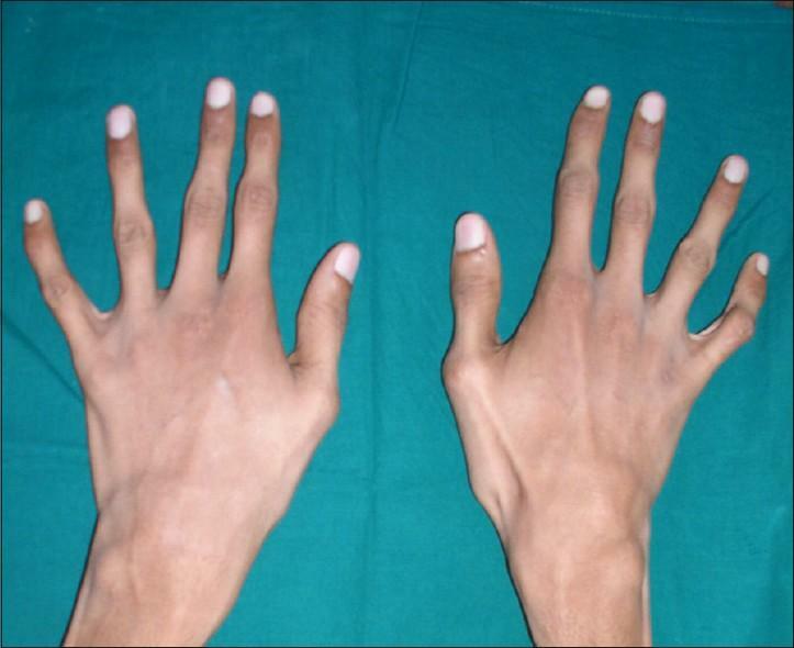 Diseases of the joints of hands