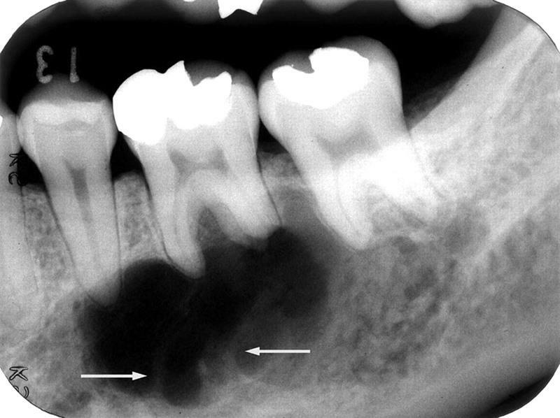 X-ray of the periostitis of the lower jaw