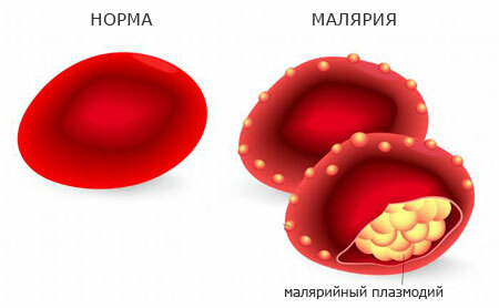 malarial erythrocytes, clinic of disease
