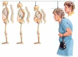 Hoe osteoporose zich ontwikkelt