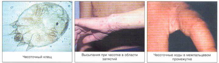 Scabies and places of its localization