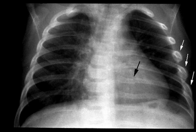 Röntgenfoto van de ribfractuur