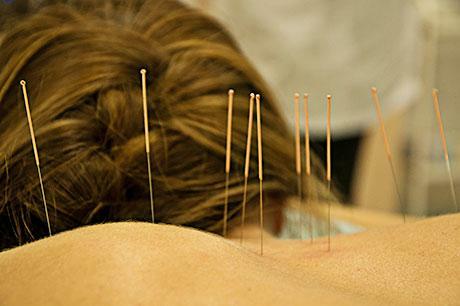 Acupunctura, acupunctura