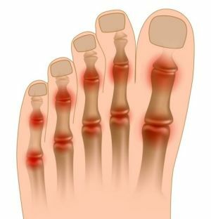 Arthritis of the toes