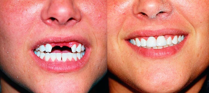 Dantų dantų protezavimas 2 dantims. Kaina, kiek, nuotrauka, atsiliepimai