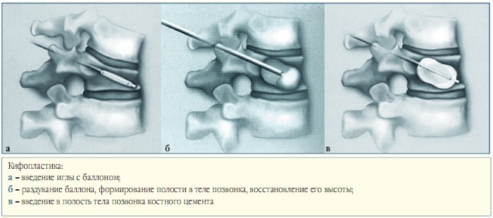 A compression fracture of the spine. What it is, treatment of the thoracic, lumbar, the elderly, children, rehabilitation
