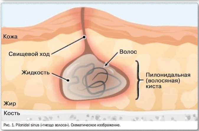Pilonidal cyste med byld. Hvad er det, behandling med og uden kirurgi