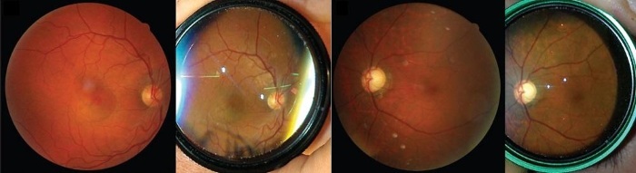 Ocular fundus. How to check what shows, the norm in adults, a child, transcript