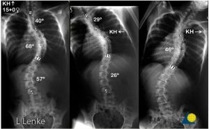Imagen de rayos X con escoliosis