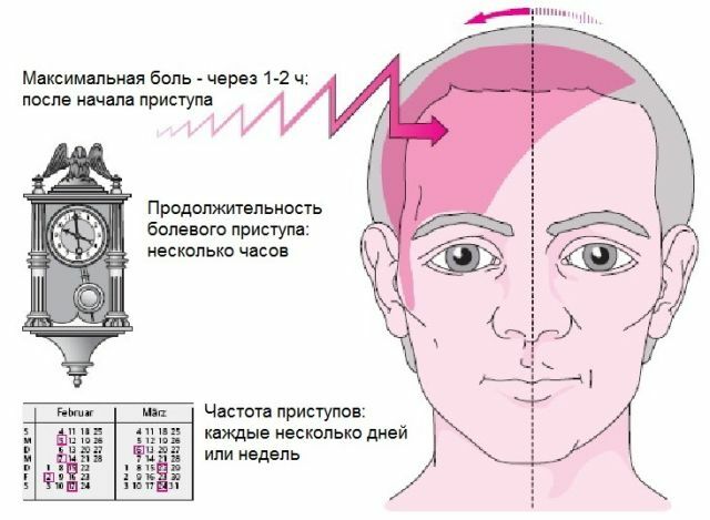 Les symptômes de la migraine
