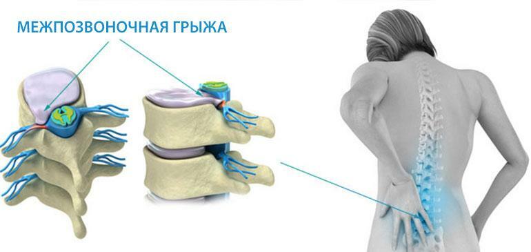 Operație pentru a elimina o hernie a coloanei vertebrale lombare