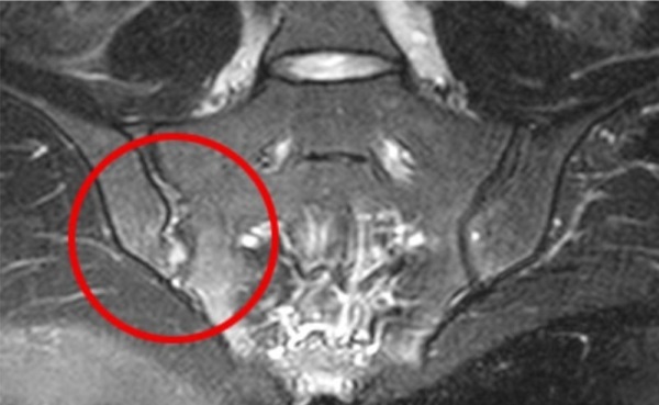 MRI of the sacroiliac joints. What is it, preparation