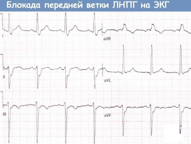 P wave (R) on the ECG. What reflects, characterizes, the norm