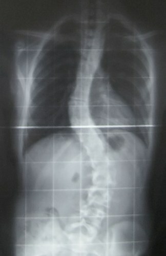 Curvature of the spine in adolescents. Treatment