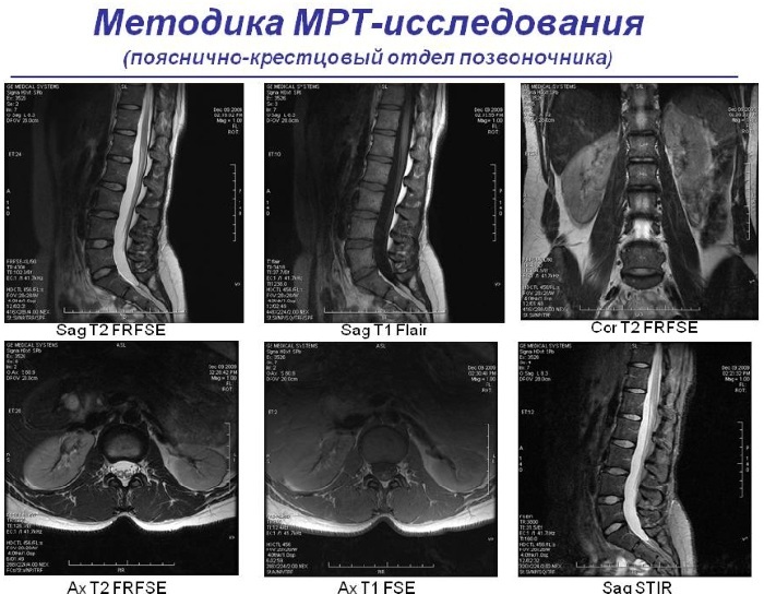 MRI of the spine. How they do it, what shows how the procedure is going, preparation for the examination