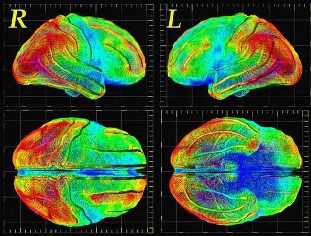 Nörolojide Beyin Pozitron Emisyon Tomografisi