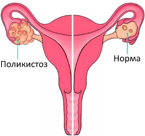 Secondary oligomenorrhea. What is it in women, girls, causes, signs, treatment