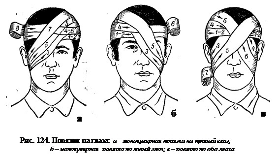 Повязка алгоритм. Бинокулярная повязка алгоритм. Наложение монокулярной повязки алгоритм. Десмургия бинокулярная повязка. Наложение повязки на оба глаза.