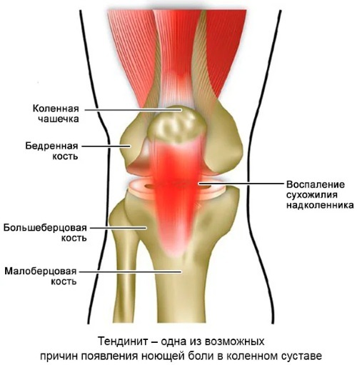 Inflammation of the tendons of the knee joint. Treatment, symptoms, causes in children, athletes, x-rays