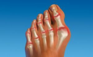arthrosis of the toes