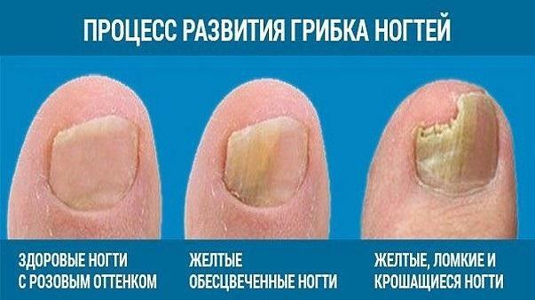 The process of development of nail fungus