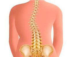 Solioza stângă a coloanei vertebrale toracice și lombare