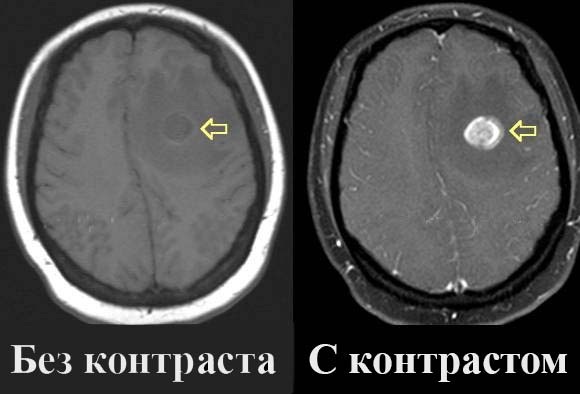 Je li MRI štetan za zdravlje? Kontraindikacije za djecu, odrasle, trudnice