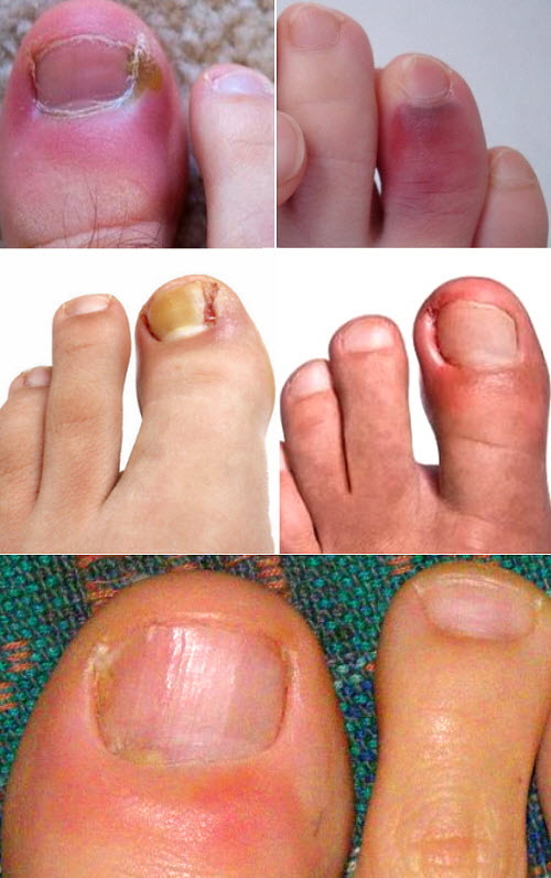 Panaritium del dedo del pie. Síntomas y tratamiento