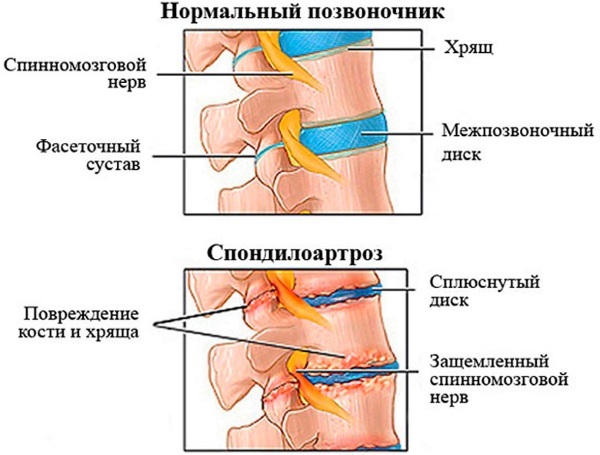 Cambios degenerativos-distróficos en la columna. ¿Qué es esta columna cervical, torácica, lumbar, síntomas, tratamiento?