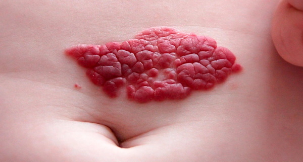 Hemangiom på huden. Foto, ultralyd, beskrivelse