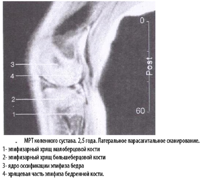 How does and what the MRI of the knee joint shows?