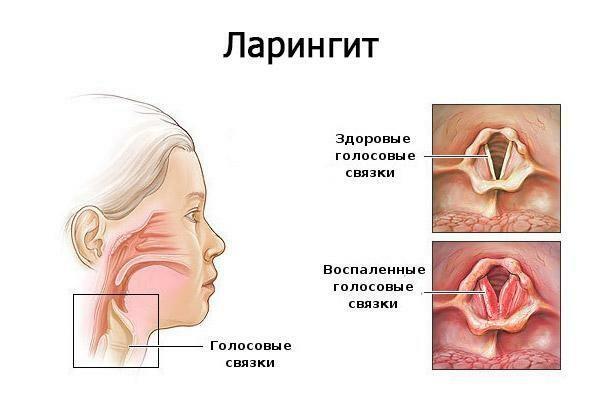 Cordes vocales avec laryngite