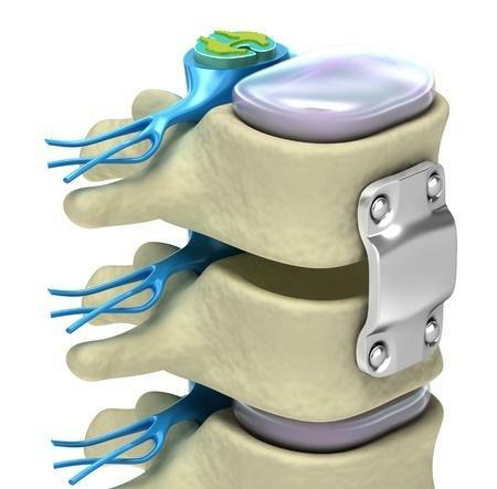 Sistemul de fixare a vertebrelor