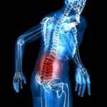 Pinça do nervo na parte inferior das costas - quão perigoso e como tratar?