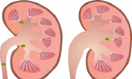 Hydronephrosis of the kidneys